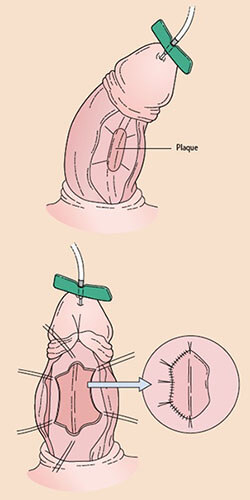 Operation nach Horton-Devine (penisverkrümmung)
